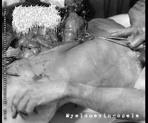 Gangrenous Erythromelalgia : Myelomenigocele